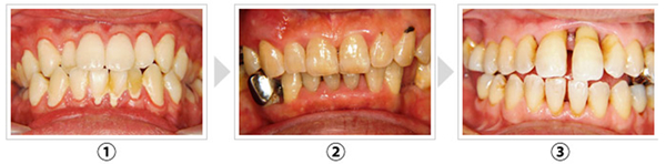 歯周病とは