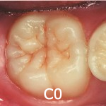 C0（エナメル質表面のむし歯）