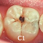 C1（象牙質に達しないむし歯）