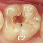 C2（象牙質に達するむし歯）
