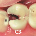 C3（歯髄に達するむし歯）