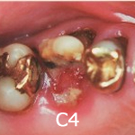 C4（歯根に達するむし歯）