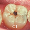 C1（象牙質に達しないむし歯）