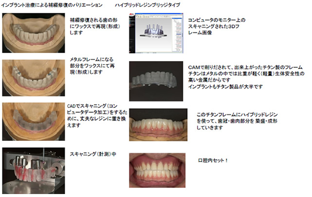 インプラントアバットメント（支台柱）のバリエーション